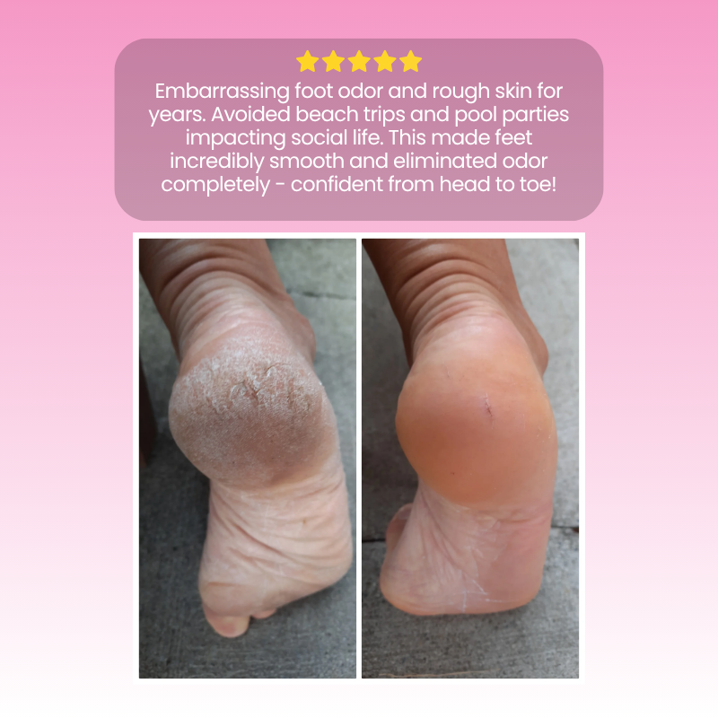 Sofitte™ Electric Foot Callus Remover