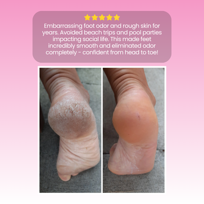 Sofitte™ Electric Foot Callus Remover