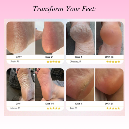 Sofitte™ Electric Foot Callus Remover